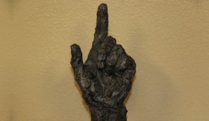 Dupuytren's Disease